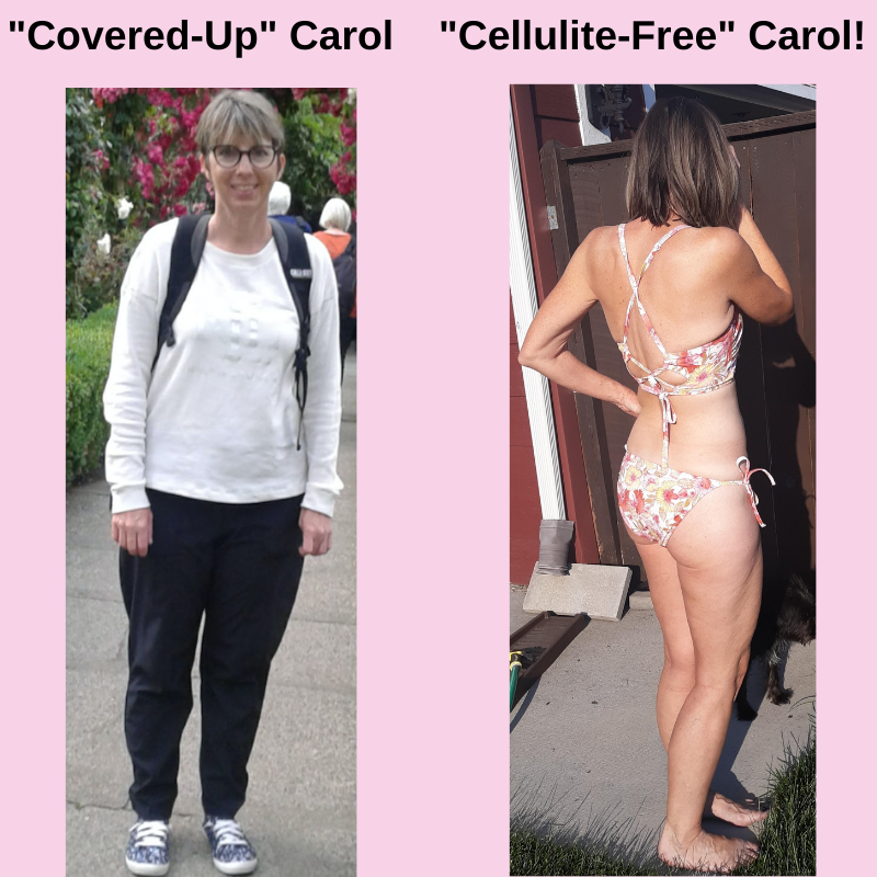 Cellulite before and after photos from Carol